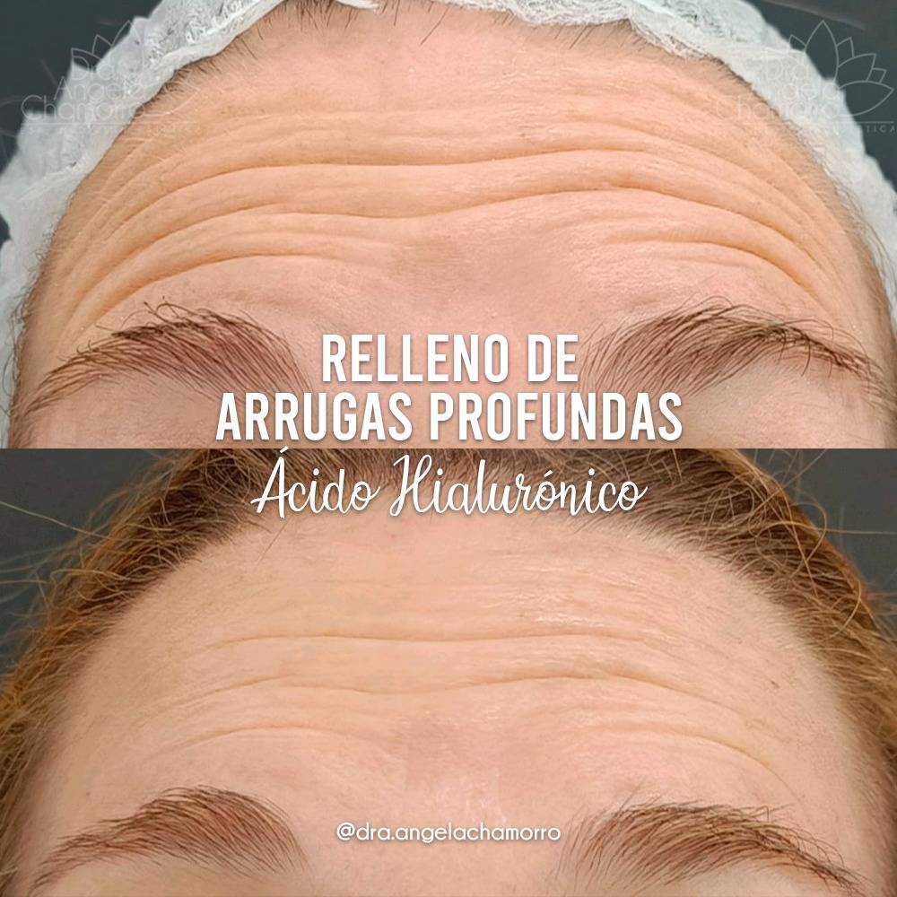 Resultado antes y después de tratamiento para arrugas faciales con Ácido Hialurónico.