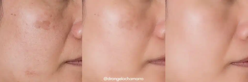 Tratamientos para la piel después del verano: peeling químico