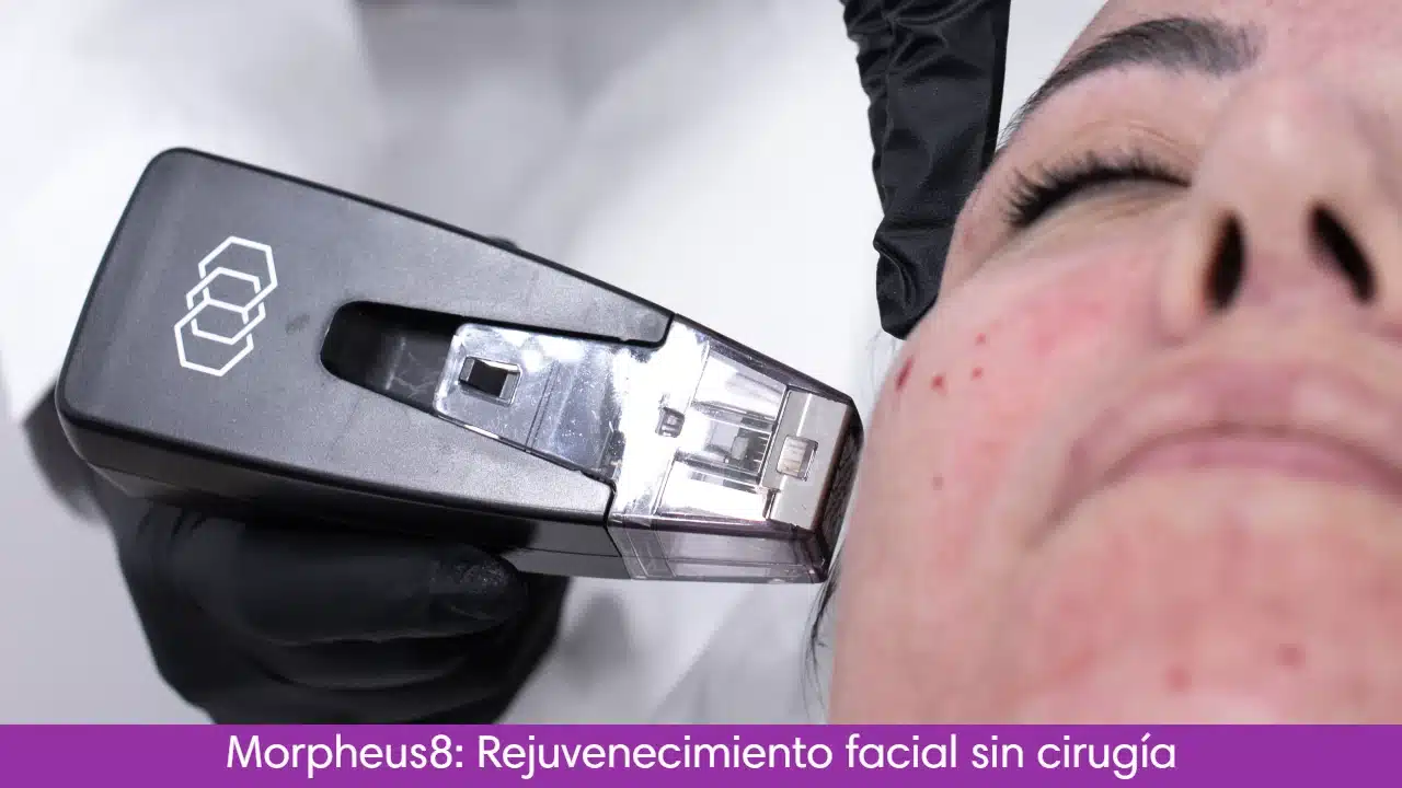 Morpheus Facial: Rejuvenecimiento sin cirugía